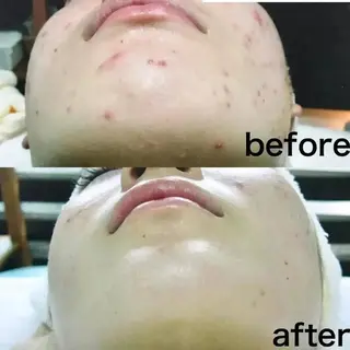 ニキビケア＆ニキビ跡 レゾン京橋店　のエステ・リラクイメージ