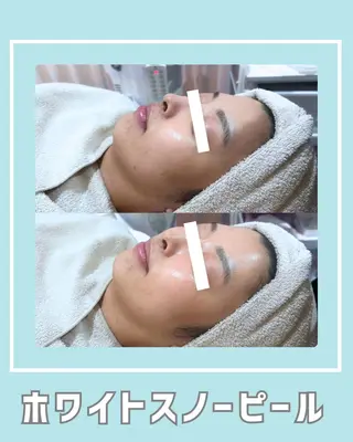 |ピーリング・毛穴| soina神楽坂のエステ・リラクイメージ