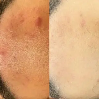 ニキビ特化型エステ 🍓最短で肌質改善のエステ・リラクイメージ