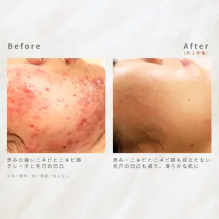 繰り返すニキビを改善 ✨つくば肌質改善専門のエステ・リラクイメージ