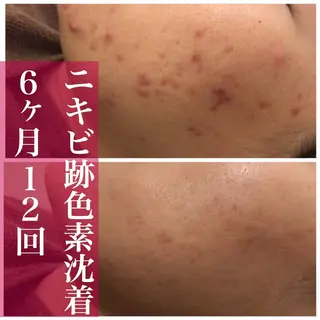 ミディアム カラー パーマ ヘアアレンジ メンズ キッズ ネイル マツエク・マツパ アイブロウ ニキビ・肌質改善専門 ♡人生が変わるサロンのエステ・リラクイメージ