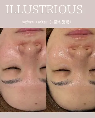 【毛穴•ハーブピーリング】 ニキビ対策サロンétoile クリスティーナ正規取扱店所属・松尾 佳奈のエステ・リラクイメージ