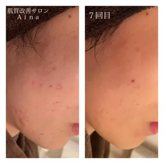 セミロング カラー パーマ ヘアアレンジ メンズ キッズ マツエク・マツパ ニキビ跡専門サロン Ainaのエステ・リラクイメージ