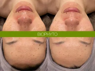 ☆痩身/小顔☆ ハイパーナイフexのエステ・リラクイメージ