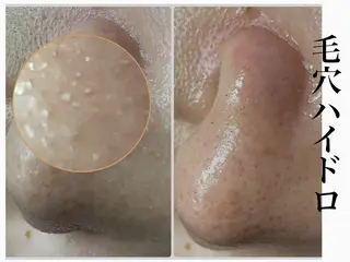 Chalon所属・REVI取扱・肌悩み 毛穴Chalonのエステ・リラクイメージ