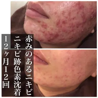 ミディアム カラー パーマ ヘアアレンジ メンズ キッズ ネイル マツエク・マツパ ニキビ・肌質改善専門 ♡人生が変わるサロンのエステ・リラクイメージ