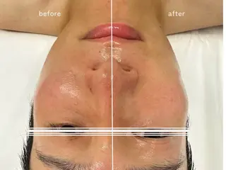 洗顔サロン池袋 毛穴洗浄のその他イメージ