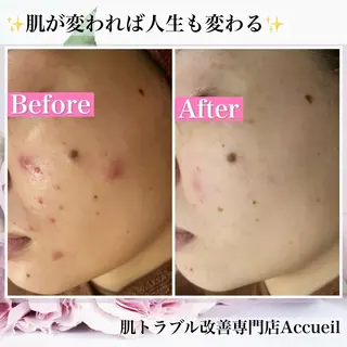 ニキビ・肌質改善専門 ♡人生が変わるサロンのエステ・リラクイメージ