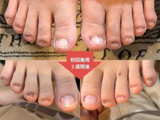 ネイル 深爪矯正・自爪育成 ネイルサロンアモまいのネイルデザイン