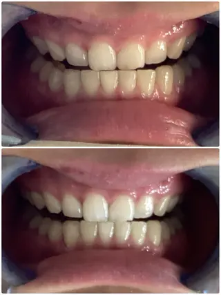 ANGEPEAU（アンジュポー）所属・セルフホワイトニング アンジュポーのその他イメージ