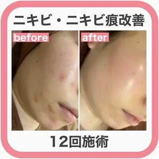 セミロング カラー パーマ ヘアアレンジ メンズ キッズ ネイル マツエク・マツパ アイブロウ 🔥3か月で肌革命 🔥ニキビ専門店のエステ・リラクイメージ