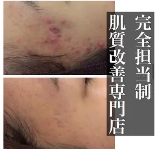 ニキビ特化型エステ 🍓最短で肌質改善のエステ・リラクイメージ