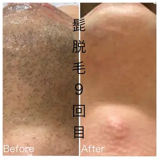 メンズ 医療提携メンズ脱毛 CDFAkasakaのエステ・リラクイメージ