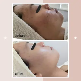 ニキビケア＆ニキビ跡 レゾン京橋店　のエステ・リラクイメージ