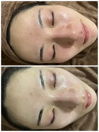 ニキビ/毛穴ケア ハーブピーリングのエステ・リラクイメージ