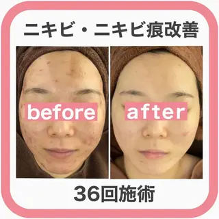 ニキビ跡改善専門🔥 医療にはできない改善のエステ・リラクイメージ