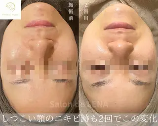 ハーブピーリング・毛穴ケア専門サロンSalon de LENA 栄店所属・ハーブピーリング専門 サロンドレナ　白藤のエステ・リラクイメージ