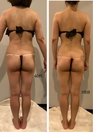 ✨痩身 ✨ハイパーナイフEXのエステ・リラクイメージ