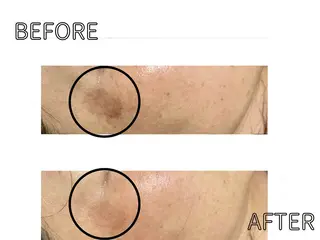 ハーブピーリング LIME池袋東口のエステ・リラクイメージ