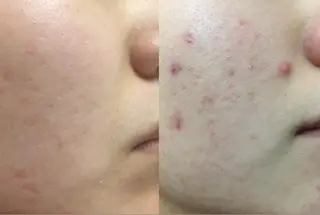 都内で出来る肌管理！ 最短ニキビ改善のエステ・リラクイメージ