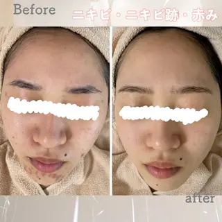 ニキビ&跡改善サロン オーナー光木のエステ・リラクイメージ