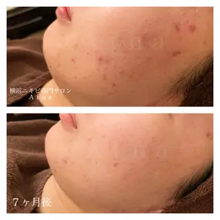 ミディアム カラー パーマ ヘアアレンジ メンズ キッズ ネイル マツエク・マツパ ニキビ跡専門サロン Ainaのエステ・リラクイメージ