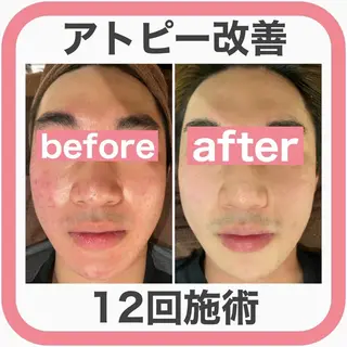ニキビ跡改善専門🔥 医療にはできない改善のエステ・リラクイメージ