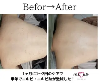 Meupニキビ専門店 背中/ハーブ/肌管理のその他イメージ
