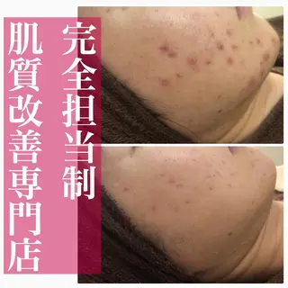 セミロング カラー パーマ ヘアアレンジ メンズ キッズ ネイル マツエク・マツパ アイブロウ 🔥3か月で肌革命 🔥ニキビ専門店のエステ・リラクイメージ