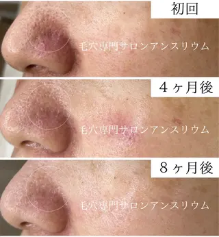 毛穴ケア専門サロンアンスリウム所属・茨城土浦 つくば毛穴 ケア専門サロンのエステ・リラクイメージ