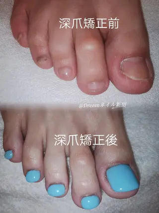 ネイル フィルイン、長さ出し 深爪矯正のネイルデザイン