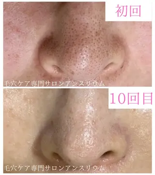 毛穴ケア専門サロンアンスリウム所属・茨城土浦 つくば毛穴 ケア専門サロンのエステ・リラクイメージ