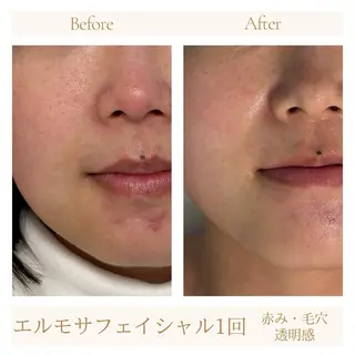 【ハーブピーリング】 Allumentのエステ・リラクイメージ