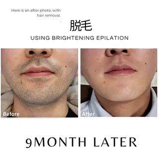 脱毛サロン　HUGME.所属・脱毛サロンHUGME 光フォトフェイシャルのエステ・リラクイメージ