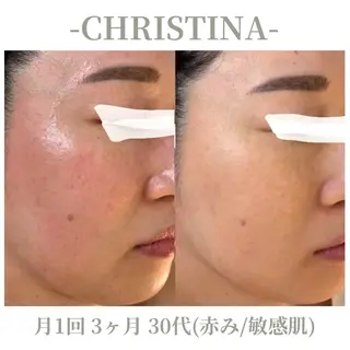 肌質改善|天王寺 For...はるかのエステ・リラクイメージ