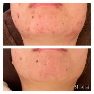 ショート カラー パーマ ヘアアレンジ メンズ キッズ ネイル マツエク・マツパ ニキビ跡専門サロン Ainaのエステ・リラクイメージ