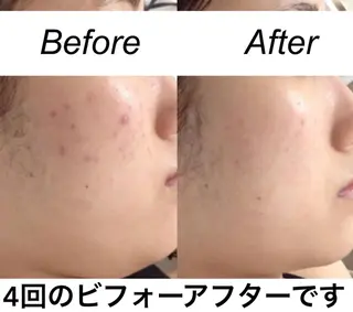 ミディアム カラー パーマ ヘアアレンジ キッズ ネイル マツエク・マツパ 都度払い肌質改善 &脱毛Blancheのエステ・リラクイメージ