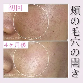 毛穴ケア専門サロンアンスリウム所属・茨城土浦 つくば毛穴 ケア専門サロンのエステ・リラクイメージ