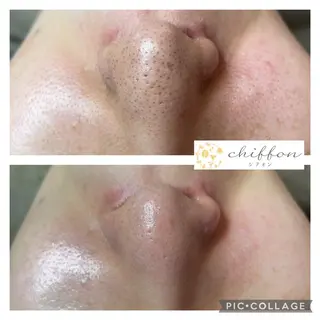 毛穴黒ずみ改善🥇 ✨シフォン豊田✨のエステ・リラクイメージ