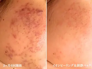 ニキビ跡改善専門🔥 医療にはできない改善のエステ・リラクイメージ