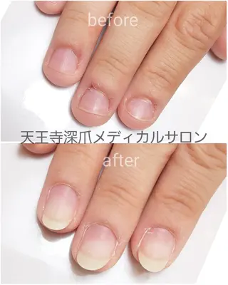 ネイル 天王寺 深爪メディカルサロンのネイルデザイン