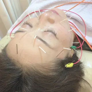 リフトアップ・たるみ ☆美容鍼小顔矯正のその他イメージ