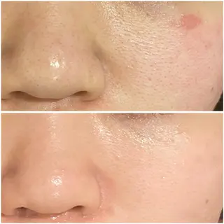 ニキビ跡改善専門🔥 医療にはできない改善のエステ・リラクイメージ