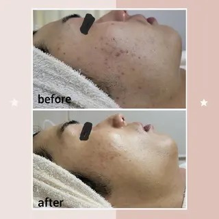 メンズ ニキビケア＆ニキビ跡 レゾン京橋店　のエステ・リラクイメージ