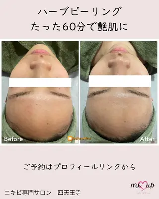 Meupニキビ専門店 背中/ハーブ/肌管理のその他イメージ