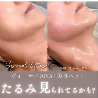 痩身ハイパーナイフ 小顔フェイシャル痩身のエステ・リラクイメージ