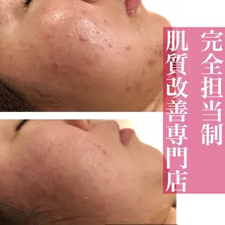 学生ニキビ改善🍀 優しい肌質改善のエステ・リラクイメージ