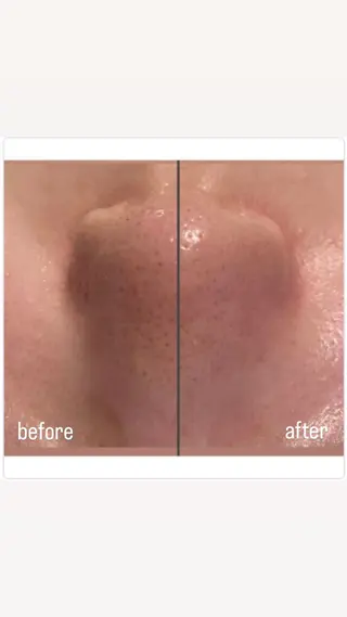 beauty clinic freep所属・freep高知♥ 毛穴🌿moritaのエステ・リラクイメージ