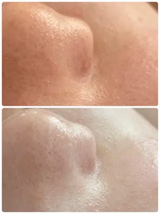 Chalon所属・REVI取扱・肌悩み 毛穴Chalonのエステ・リラクイメージ