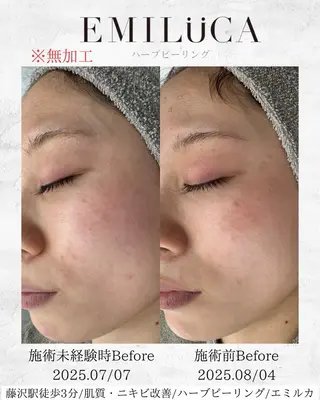 ハーブピーリング専門EMILUCA藤沢所属・ハーブピーリング /KAEDEのエステ・リラクイメージ